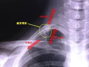 骨折 と は 疲労